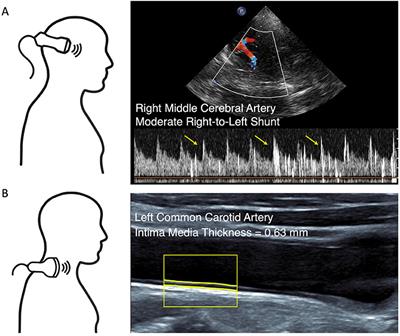 Bubble Test and Carotid Ultrasound to Guide Indication of Transesophageal Echocardiography in Young Patients With Stroke